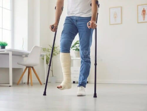 Temporary Accommodations leg with cast on it and crutches